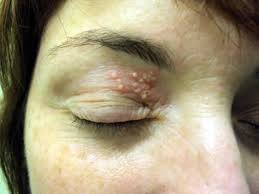 Image result for Herpes Simplex