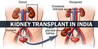 Living Donor Kidney Transplant Cost In India