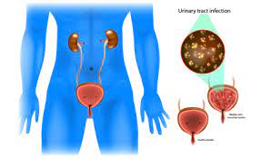 Urinary tract infection (uti) is commonly thought to be a woman's disease. Utis In Men And What You Need To Be Aware Of Medanta