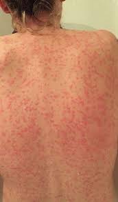 Anaphylaxis is a rare but severe allergic reaction. Anaphylactic Shock Would You Know What To Do Hba Training
