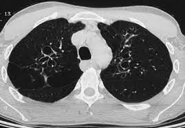 Healthcare providers consider your medical history, risk factors, symptoms, physical examinations, and lab tests when diagnosing aspergillosis. Pulmonary Aspergillosis A Clinical Review European Respiratory Society