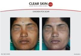 Pin On Chicken Pox Scars Results Before And After Clearskin Pune