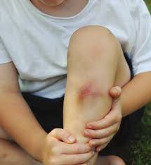 Image result for Skin Trauma