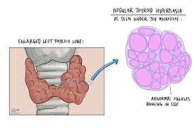 Nodular Thyroid Hyperplasia Of The Thyroid Gland Mypathologyreport Ca