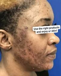 please what be used to clear rashes or pimple