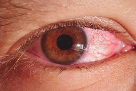 Image result for Eye Pain