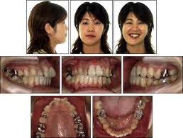 It's perfect for adults who don't want or are uncomfortable with braces. Severe Facial Asymmetry And Unilateral Lingual Crossbite Treated With Orthodontics And 2 Jaw Surgery 5 Year Follow Up Pocket Dentistry