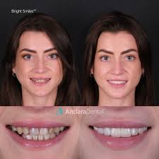 💎 Elisha's new smile can be summed up in just two words ✌️😎 Bright and  beautiful. 3 easy steps of your dental journey 👇🏻 🤳🏻 Send your  #brightsmile 📑 Take advantage of