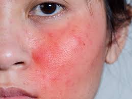 5 Different Types Of Skin Blemishes On The Face And Its Treatments Skinkraft