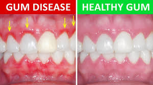 Periodontitis is an inflammatory disease that affects the periodontium, which is the periodontitis is therefore a progressive loss of alveolar bone around teeth. Periodontitis Gum Disease A Troubling U S Health Epidemic