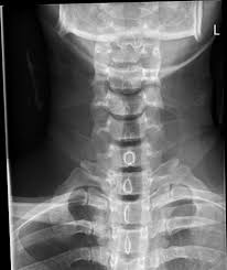 We did not find results for: C5 Facet Fracture Radiology Case Radiopaedia Org
