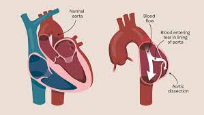 Aortic dissection - Guys and St Thomas Specialist Care