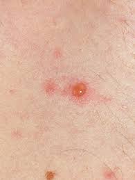 What does chicken pox look like? Chickenpox