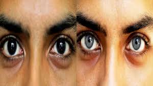 Eye Surgery With Permanently Eye Color Change Change Eye Color Surgery Change Eye Colour Change Eyes Color Brigh Eye Color Change Eye Surgery Eye Color