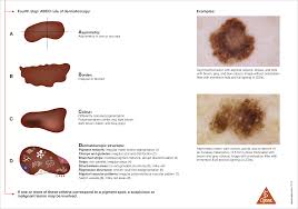 According to the american cancer society, just over 100,000 new cases of skin cancer are diagnosed in the united states each year. Early Detection Abcde Rule Heine Optotechnik
