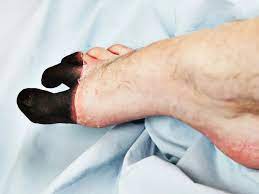 We did not find results for: Frostbite And Other Cold Weather Foot Conditions