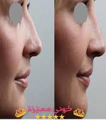 Botox Injection حقن البوتوكس علاج التجاعيد علاج الشعر بالبوتوكس Botox Injections Botox Injections