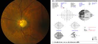 Glaucoma Why Veterans Need Regular Eye Exams Vantage Point