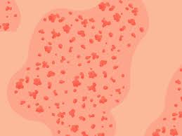 By comparison, for competitive brands like marlboro and newport, women comprise 40 percent to 50 percent of customers. Skin Rash 9 Questions That Will Help You Decode That Skin Rash Self
