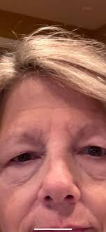 Recovery after blepharoplasty surgery