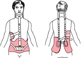 Milwaukee Brace For Scoliosis Balances The Curve And Halts Progression Should Be Worn 23 Hrs Out Of The Day Only Of Scoliosis Brace Milwaukee Brace Scoliosis