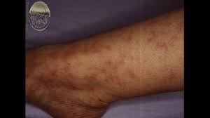 More common in the winter. Mottled Skin Causes Symptoms Pictures Treatment And More