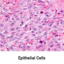 Car t cells are also being explored as a treatment for several other types of cancer, including lymphoma, lung cancer, breast cancer, mesothelioma, ovarian cancer, and multiple myeloma. Mesothelioma Histology A Study Of Mesothelioma Cells