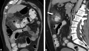Ovarian cancer is often referred to as the silent killer for a good reason: Appendicitis And Diverticulitis Of The Colon Misleading Forms Sciencedirect