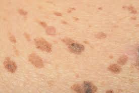 Simply apply to the face directly and leave on. How To Get Rid Of Dark Spots On The Face From Sun Acne And More