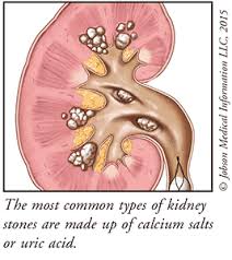 Image result for Calcium Nephrolithiasis