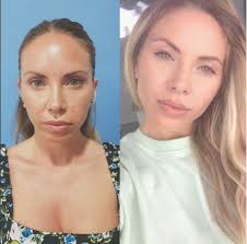 Esse procedimento consiste em remover o excesso de gordura das bochechas e assim garantir um rosto mais fino. Bichectomia En Madrid Extraccion Bolas De Bichat Dr Edgar Quintero