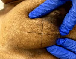 What are the symptoms of inflammatory breast cancer? Case Of Idiopathic Granulomatous Mastitis Recognition Of A New Management Paradigm
