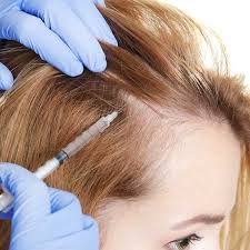 Image result for Alopecia