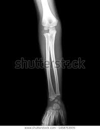 Add a layer mask to the current layer (layer> add layer mask> reveal all). Xray Radiology Details Radioanatomy Brachial Antebrachial Stock Photo Edit Now 1458753935 Photo Editing Stock Photos Brachial