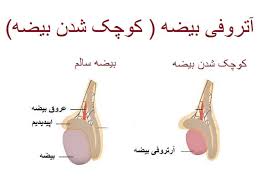 آیا ورم بیضه باعث ناباروری میشود؟