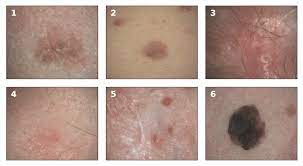 So it&#x27;s important to check your skin once a month or so. Examples Of Melanoma And Non Melanoma Skin Cancer Taken In A Clinical Download Scientific Diagram