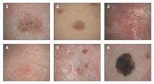 This is the most aggressive type of melanoma.it accounts for 10 to 15 percent of all cases. Examples Of Melanoma And Non Melanoma Skin Cancer Taken In A Clinical Download Scientific Diagram