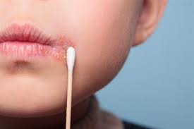 There are 5 cold sore stages. Cold Sores Herpes Simplex