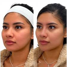 Jawline Contouring for Men & Women: Transform and Enhance