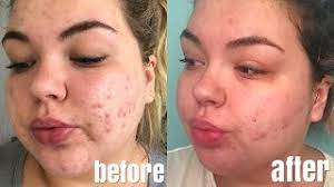 How much is accutane with insurance. Where To Buy Accutane In Tucson Online Accutane Generic Brands Goliath The Destiny Of Multinational Companies By Milton Kotler 2013 Kotler On Growth