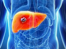 Its main function is secretion of bile and detoxification of unprocessed chemicals in the body. Liver Cancer Treatment Signs Symptoms Treatment Lyfboat