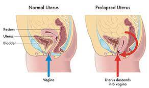 Uterusprolaps Ursachen Symptome Behandlung Medlexi De