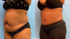 How much does a tummy tuck cost? 44 Woman After Tummy Tuck W Lipo 360 Petrungaro Plastic Surgery