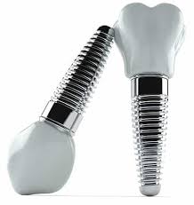 Best dental insurance plans for implants. Dental Implants And Insurance Which Plans Cover It Dental Net