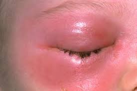 Image result for yellow scabs on the face in children