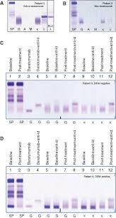 The amount of m protein in the blood or urine is measured by serum protein electrophoresis (spe or spep) or urine protein. Interference Of Daratumumab In Monitoring Multiple Myeloma Patients Using Serum Immunofixation Electrophoresis Can Be Abrogated Using The Daratumumab Ife Reflex Assay Dira