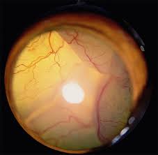 The term retinal tears and holes may be used interchangeably by some retina specialists. Retinal Detachment Veterian Key