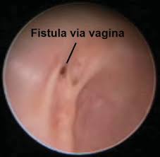 Meaning of fistula medical term. The Uretherovaginal Fistula Via Vagina Download Scientific Diagram