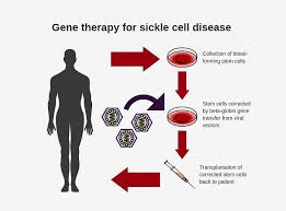 Sickle cell anemia is an inherited blood disorder that causes chronic anemia, periodic episodes of in sickle cell anemia, the red blood cells become rigid and shaped like crescents, or sickles, rather. Nih Researchers Create New Viral Vector For Improved Gene Therapy In Sickle Cell Disease National Institutes Of Health Nih
