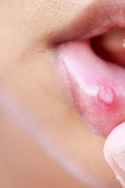 Behcet S Disease Treatment Lifestyle Tips And Causes